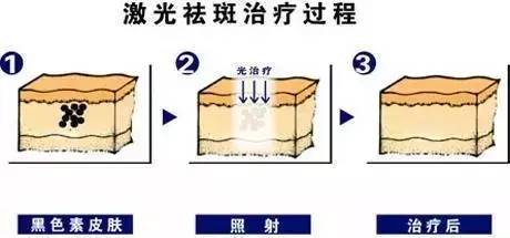 现在祛斑最新的技术