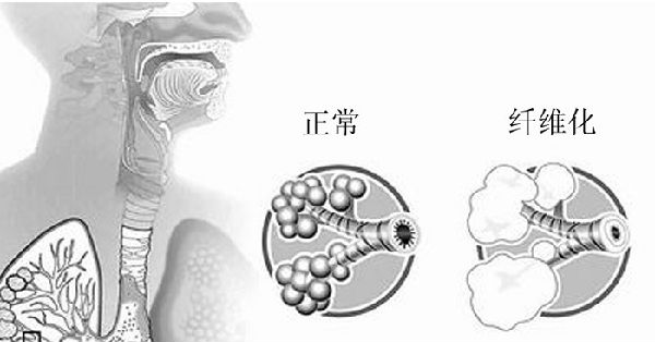 肺纤维化最新治疗方案