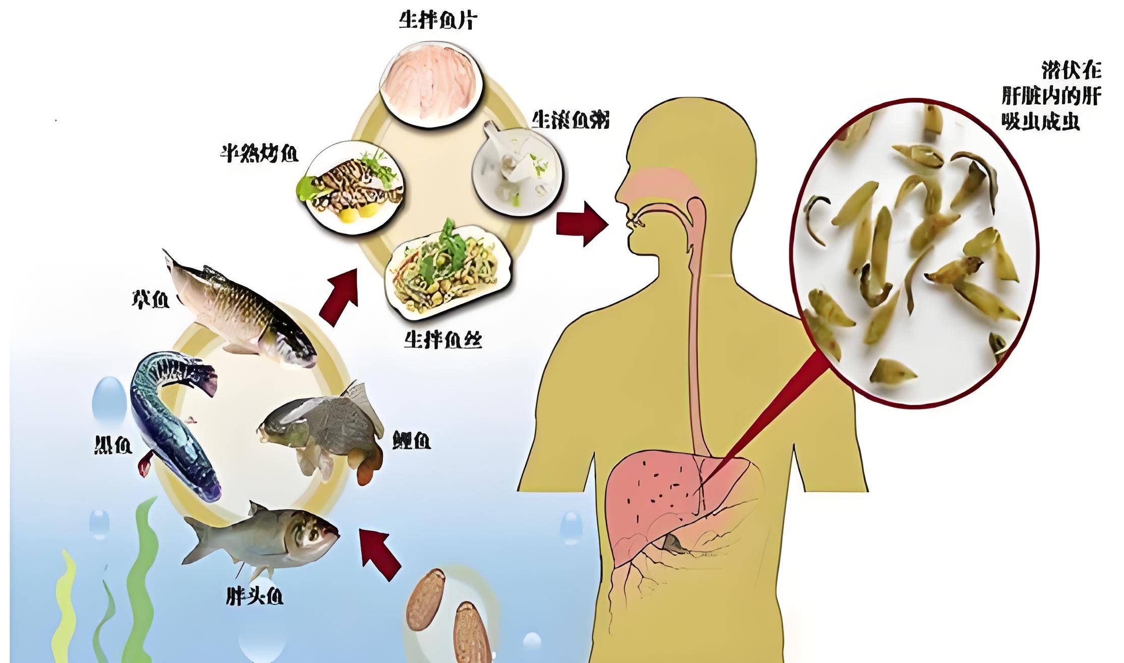 男子生食腌制食物致胆道感染七条虫，预防与应对指南